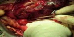 Giant spigelian strangulated hernia