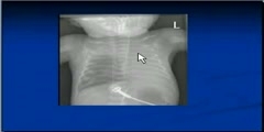 Chest x-ray interpretation ET tube position video