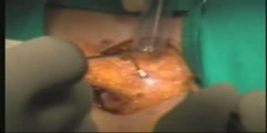 Laser Surgery - Pilonidal Cyst removal
