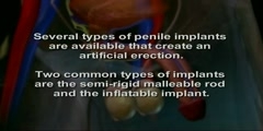 How Penile Implants Function