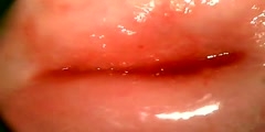 Colposcopy  Old Lacerations VIdeo