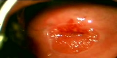 Colposcopy ectropion