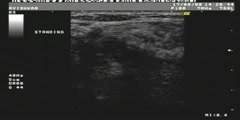 Spigelian hernia on Uultrasound