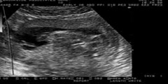 First Trimester Screening Ultrasound
