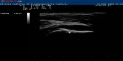 Shoulder Ultrasound