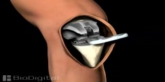 Animation of Knee Replacement Surgery