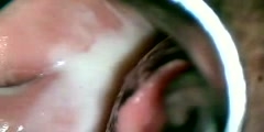 Colposcopy  Exocervicitis Purulenta