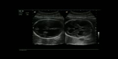 Corpus callosum agenesis ultrasound
