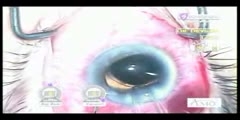 Tube shunt surgery for glaucoma