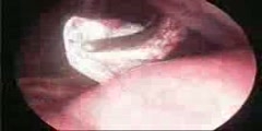 Ventral Hernia Laparoscopic Repair  Surgery Video