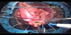 Perineal rectosigmoidectomy Altemeier Procedure