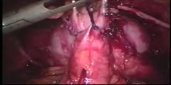 Robotic prostatectomy methods