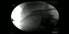 Lumbar disc nucleoplasty using coblation