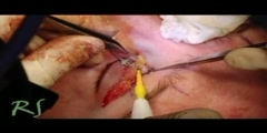Facelift Surgery Video