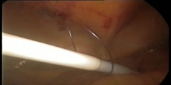 Laparoscopic placement of tenckhoff catheter