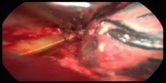 Videoscopic Assisted Retroperitoneal Debridement for Infected Necrotizing Pancr Video