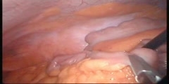 Switch of the Loop Duodenal