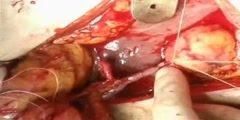 How to Revascularize Gastric Tube After Esophagectomy