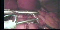 Quick stitch endoscopic sutering