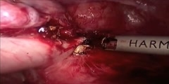 Total hysterectomy laparoscopic operation