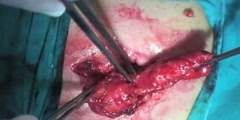 Umbilical hernia repair Surgery
