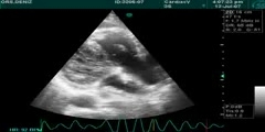 Echocardiographic Diagnosis of Pulmonary Embolism