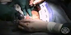 Coronary artery bypass grafting cabg