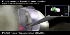 Live Partial knee replacement surgery in India