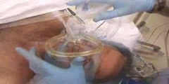 Intubation of the esophagus