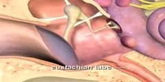 Otitis media animation