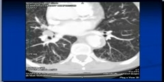 Defining CT Scan