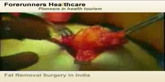 Fat Removal Surgery in India