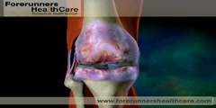 Knee Replacement Surgery - India