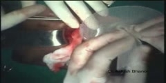 Hernia repair with prolene hernia system