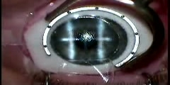 LASIK eye surgery operation  recovery and side effects