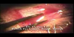 Shallow chamber cataract surgery