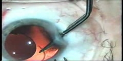 Observe an Actual Intraocular Lens Implantation