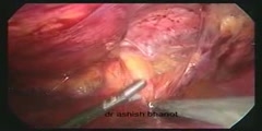 Laparoscopic transabdominal preperitoneal hernia repair for direct inguinal