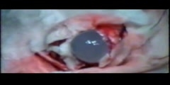 Hydatid Cyst Removal