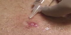 Injection of local anesthesia