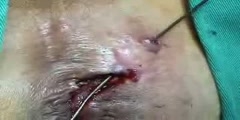 Fistulectomy Procedure