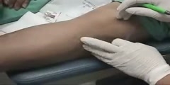 What is the tecnique for popliteal peroneal nerve block