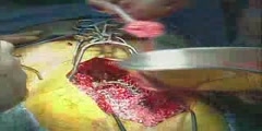 Live Pediatric Spinal Fusion Operation