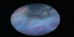 Arachnoid cyst of endoscopic fenestration