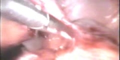 Appendectomy with corpus Luteal rupture Treatment