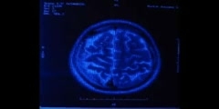 Arachnoid Cyst Seen on Brain Scans