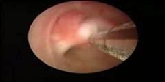 Procedure of the endometrial polyp shaver (IUR)