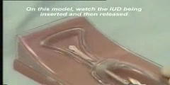 Insertion of Intra-Uterine Device IUD