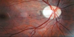 Diabetic Retinopathy Screening