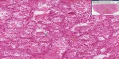 Thyroid histology of hyperthyroid graves disease